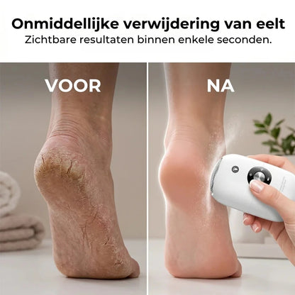 Elektrische eeltverwijderaar voor voeten