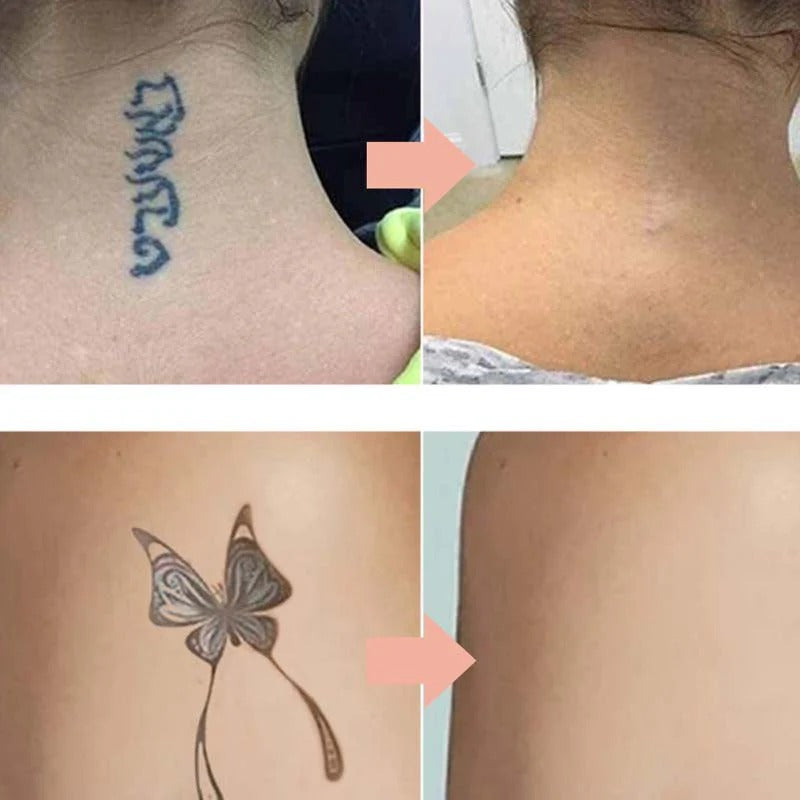 Effectieve crème voor tattoo vervagen met een zachte en veilige formule